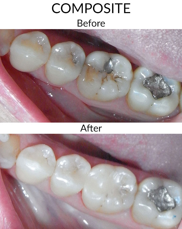Composite Before & After