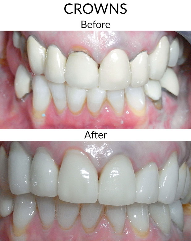 Crowns Before & After