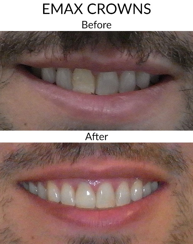 Emax Crowns Before & After