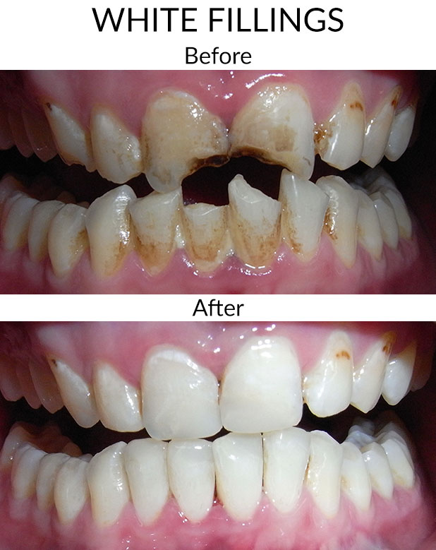 White Fillings Before & After