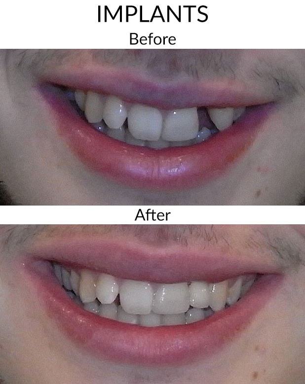 Implants Before & After