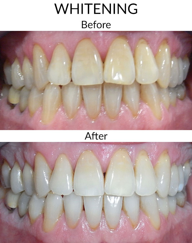 Whitening Before & After