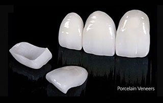 veneers